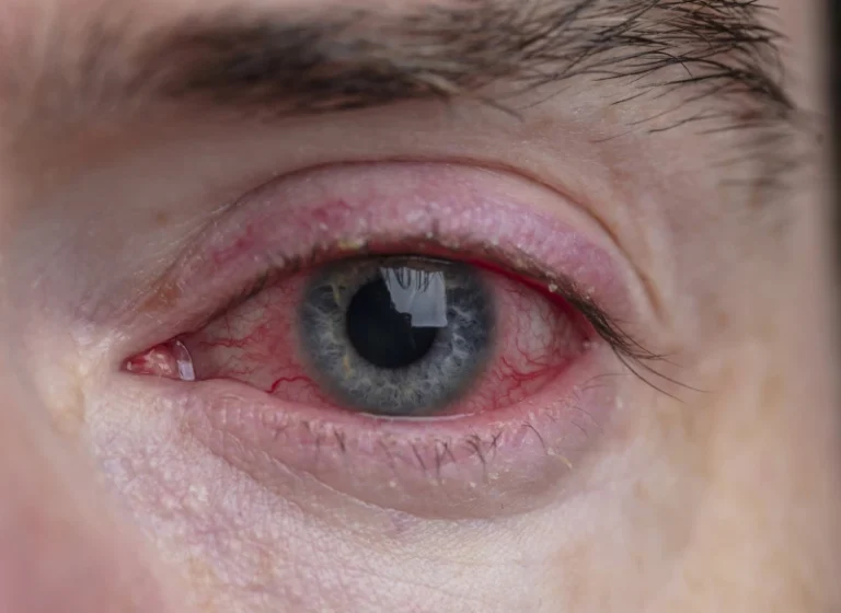 Conjuntivitis – diagnóstico y tratamiento en Liniers