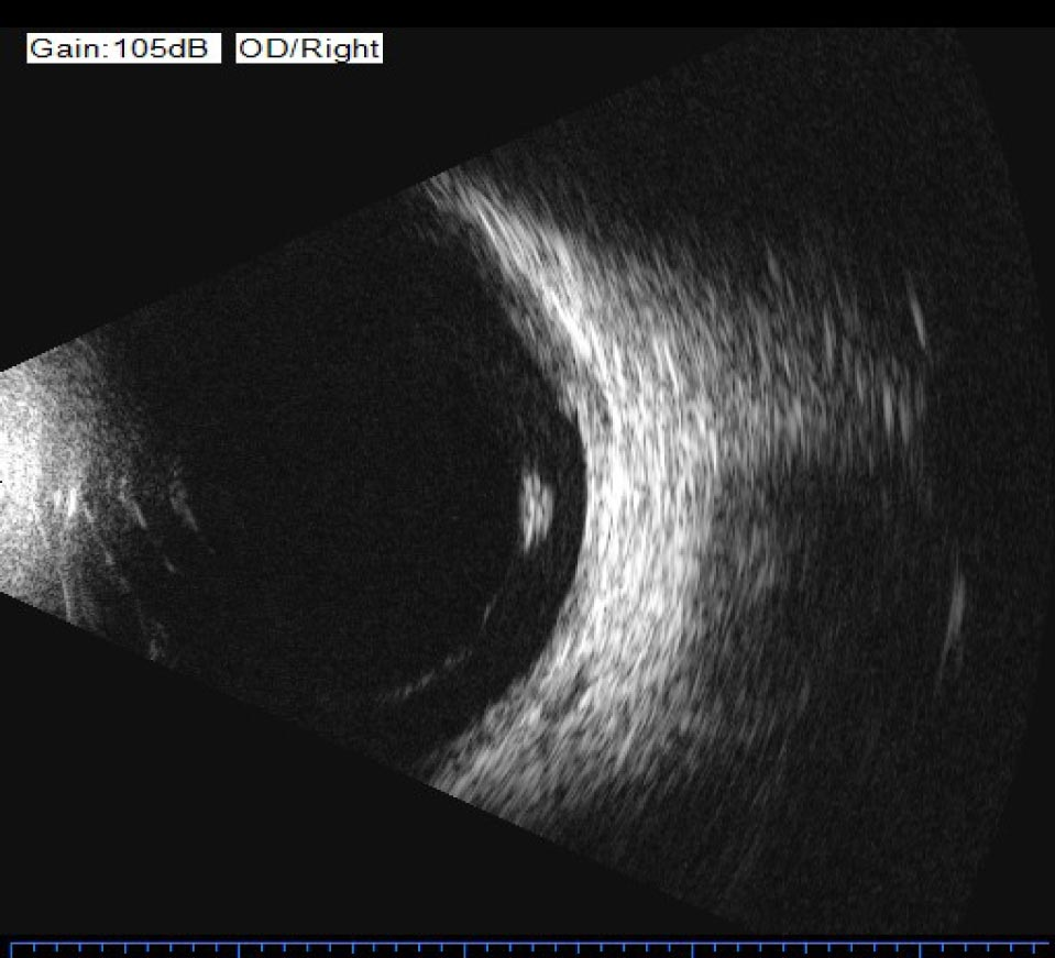 Ecografía ocular modo B – Centro de Ojos Liniers
