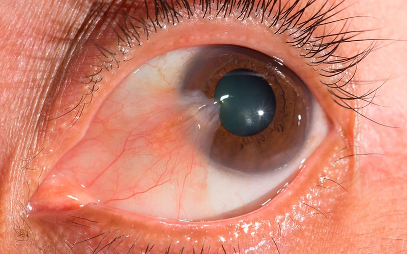 Pterigión – carnosidad ocular