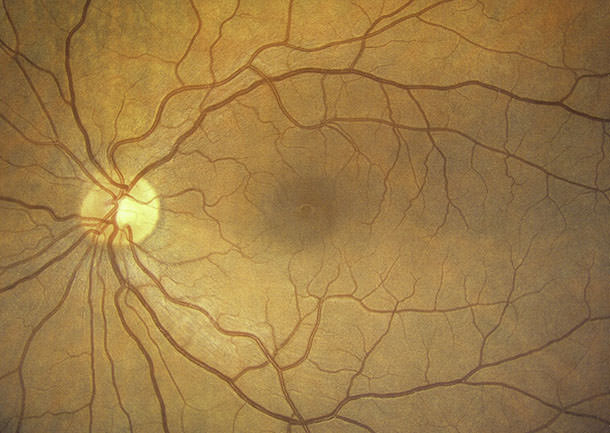 Retinografía fondo de ojo Liniers