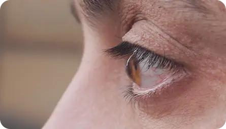 Cirugía refractiva LASIK dejar anteojos