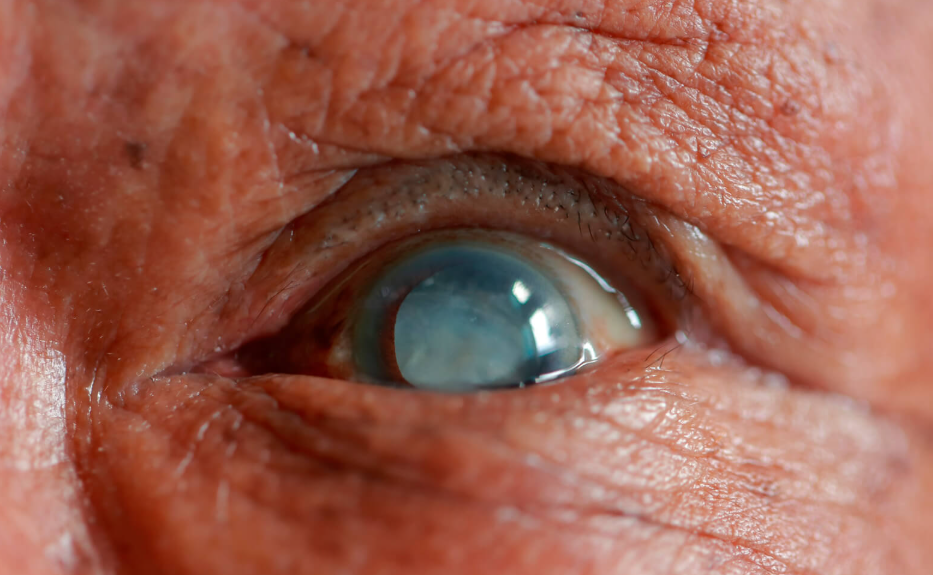 Cataratas – Cirugía de cataratas en Liniers